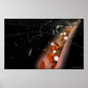 Plaque in the arteries poster