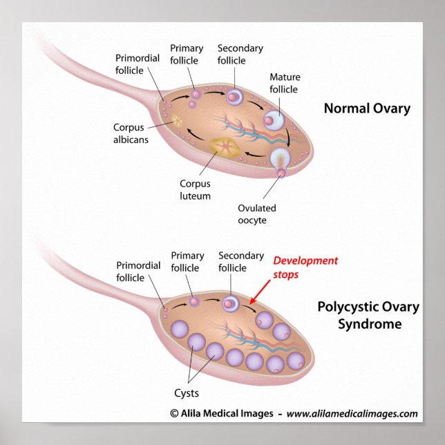Polycystic ovary syndrome, labelled diagram. poster (Front)