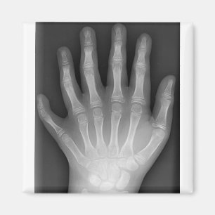 Polydactyly, Six Fingered Hand, X-Ray, rarity! Magnet