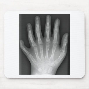 Polydactyly, Six Fingered Hand, X-Ray, rarity! Mouse Mat