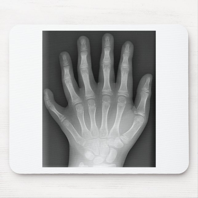 Polydactyly, Six Fingered Hand, X-Ray, rarity! Mouse Mat (Front)