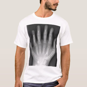Polydactyly, Six Fingered Hand, X-Ray, rarity! T-Shirt