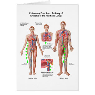 Pulmonary Embolism, Pathway Of Embolus