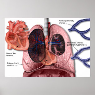 Pulmonary hypertension poster