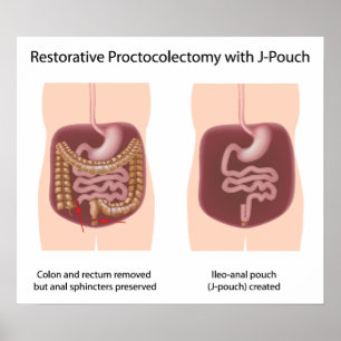 Restorative proctocolectomy surgery with j-pouch poster
