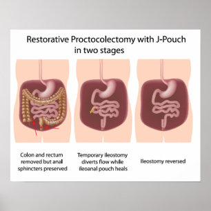 Restorative proctocolectomy with j-pouch 2 stages poster