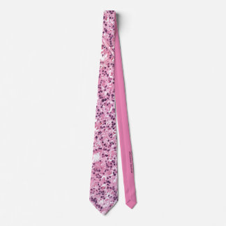 Retinocytoma: Fleurettes Tie