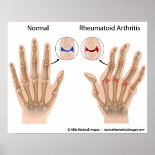 Rheumatoid arthritis of finger joints, diagram. poster