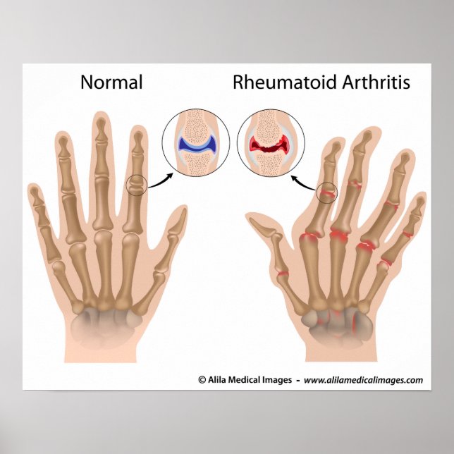 Rheumatoid arthritis of finger joints, diagram. poster (Front)