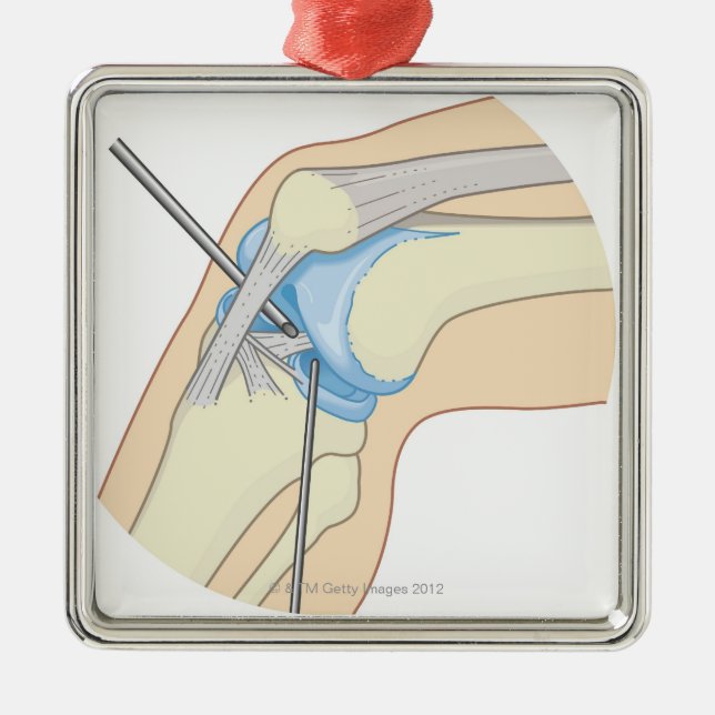Rigid Endoscopy Procedure Metal Tree Decoration (Front)