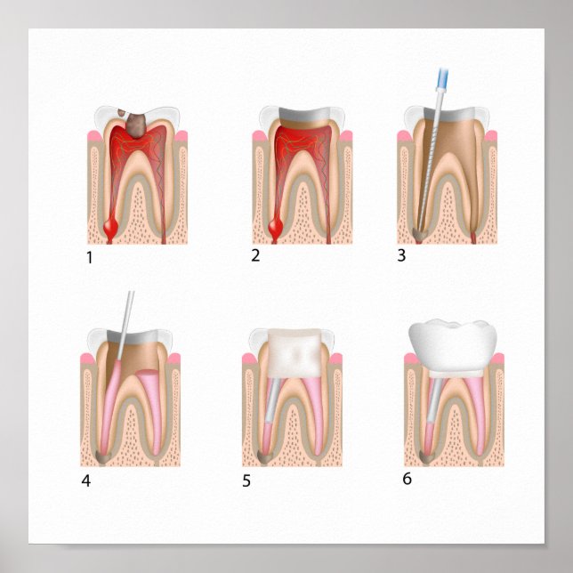 Root canal treatment Any size Poster (Front)