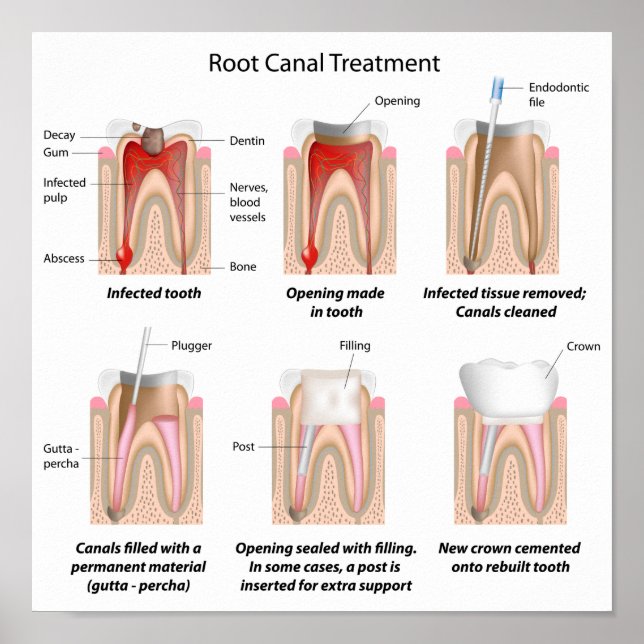 Root canal treatment Poster (Front)