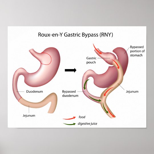 Roux-en-Y Gastric Bypass surgery poster | Zazzle.co.uk