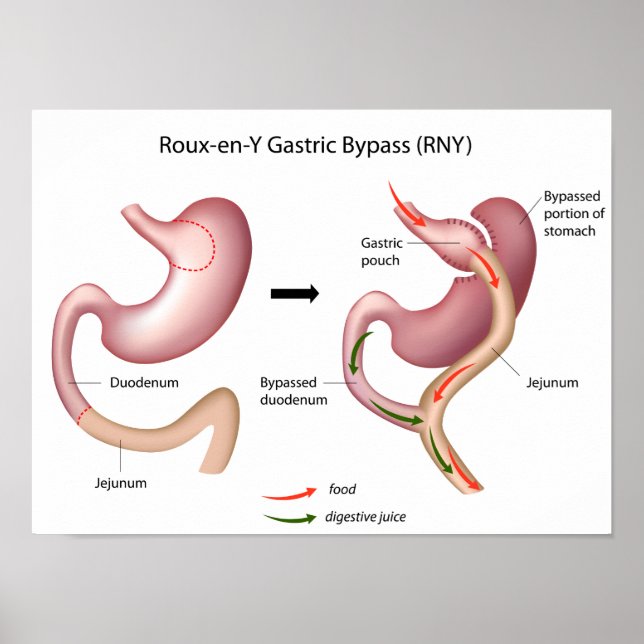 Roux-en-Y Gastric Bypass surgery poster (Front)