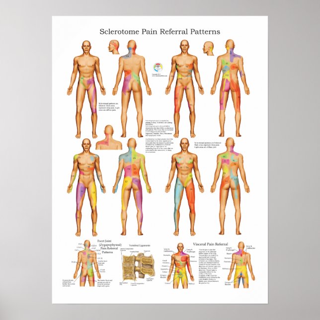 Sclerotome Visceral Pain Referral Poster (Front)
