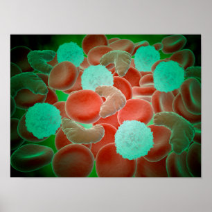 Sickle Cell Anaemia With Red Blood Cells Poster