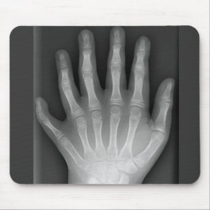 Six Fingered Hand, Medical Rarity, X-Ray Mouse Mat