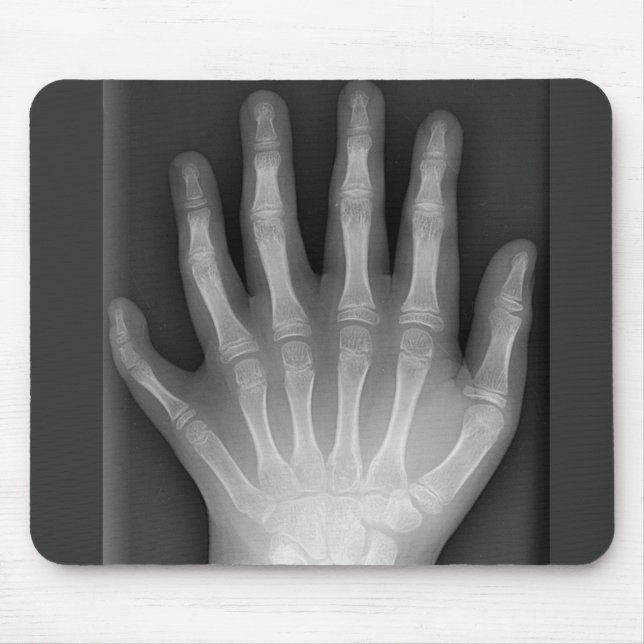 Six Fingered Hand, Medical Rarity, X-Ray Mouse Mat (Front)