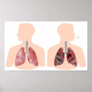 Smoking and lung cancer Poster