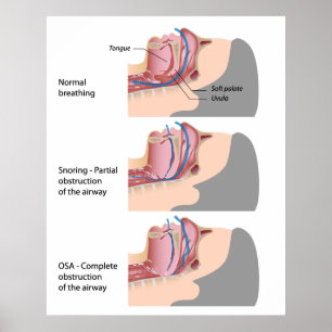 Snoring and sleep apnoea Poster