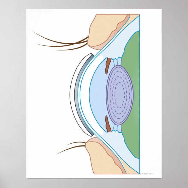 Soft Contact Lens Poster (Front)