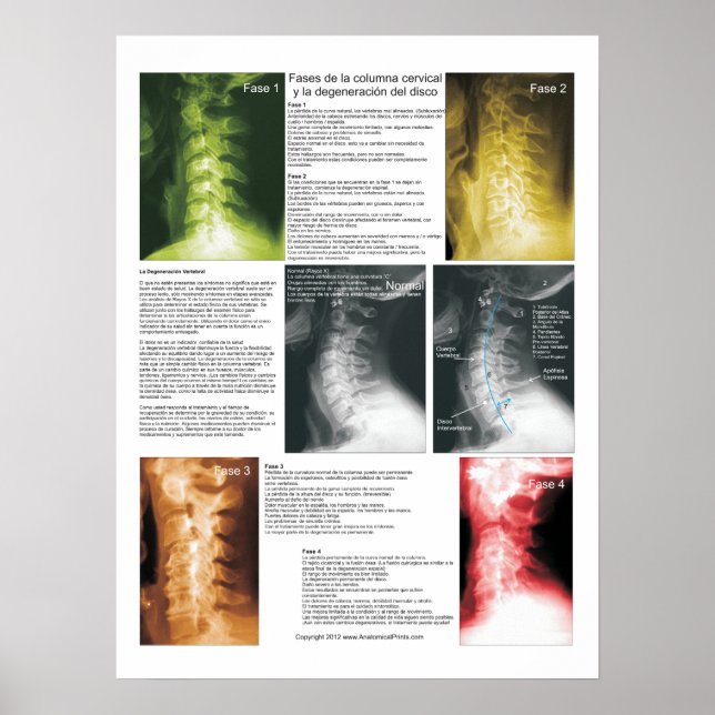 Spanish Phases Cervical Spinal Degeneration Poster (Front)