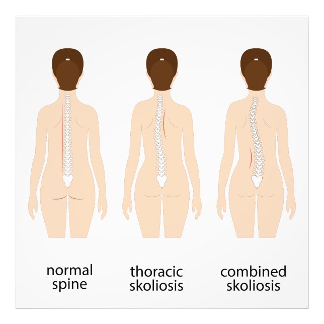Spinal deformity photo print (Front)