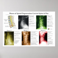 Spinal Degeneration Cervical Spine Chiropractic
