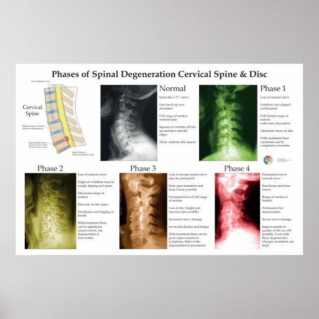 Spinal Degeneration Cervical Spine Chiropractic Poster (Front)