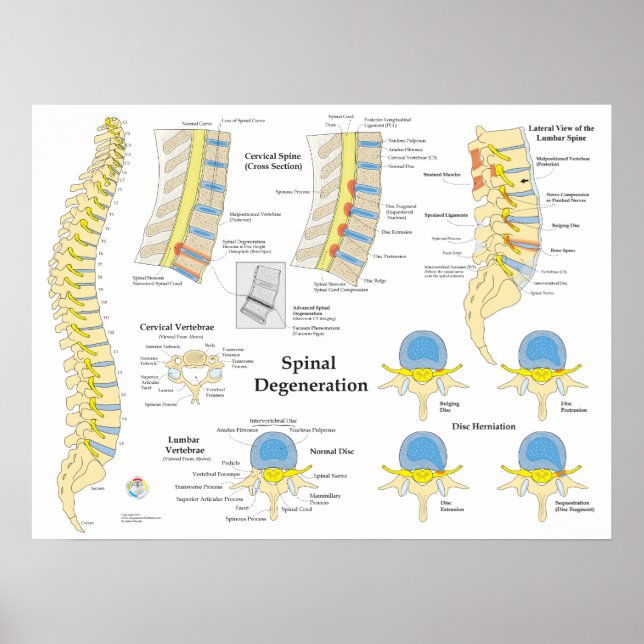 Spinal Degeneration Disc Herniation Poster (Front)