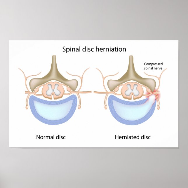 Spinal disc herniation Poster (Front)