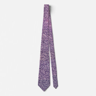 Spindle melanoma necktie