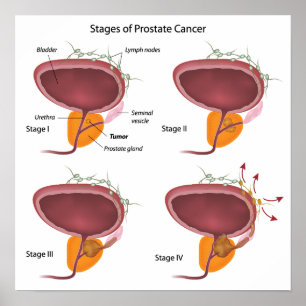 Stages of prostate cancer Poster