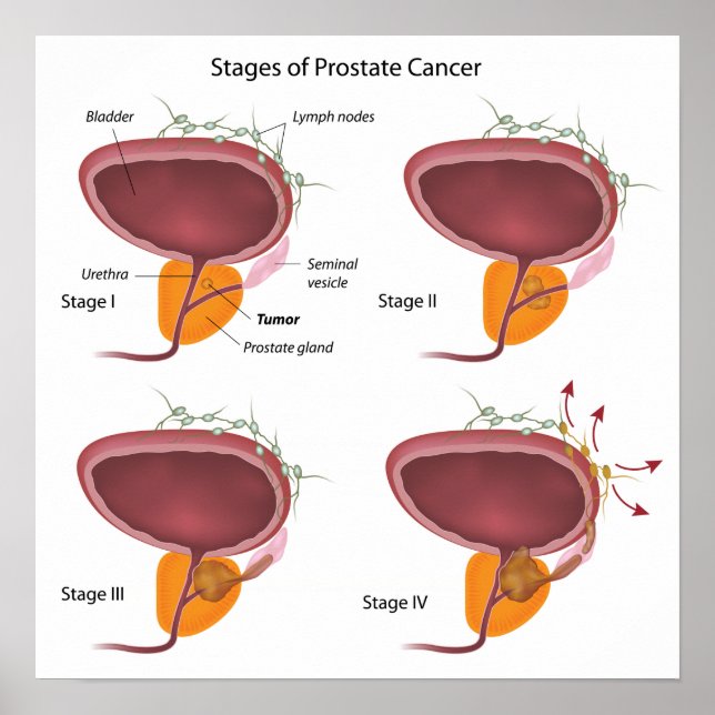 Stages of prostate cancer Poster (Front)
