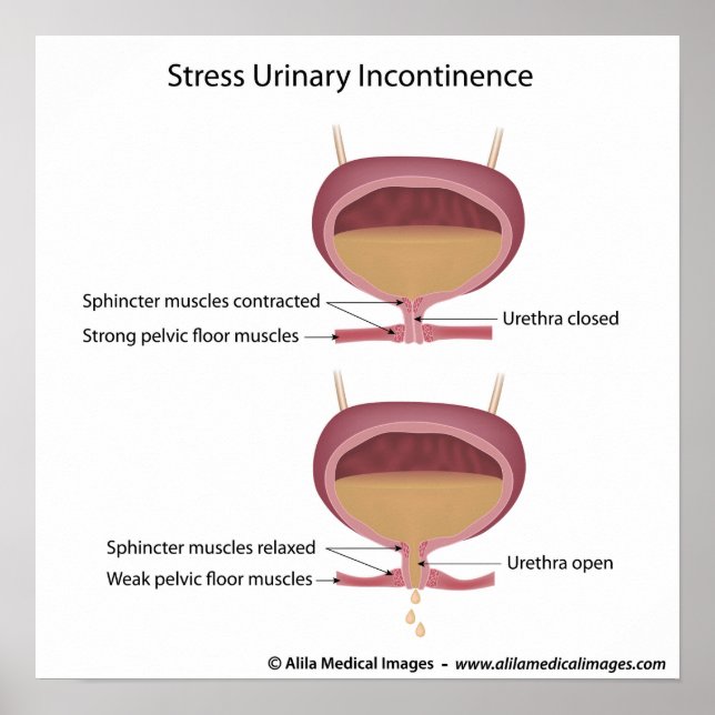 Stress urinary incontinence in women. poster (Front)