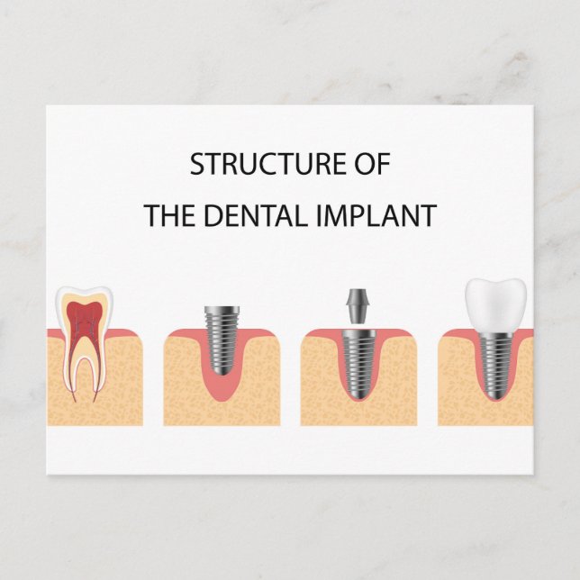 Structure of the dental implant announcement postcard (Front)