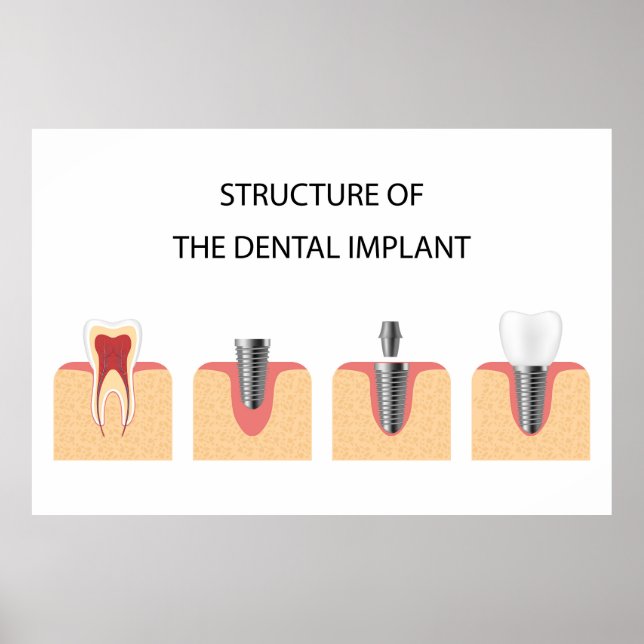 Structure of the dental implant poster (Front)
