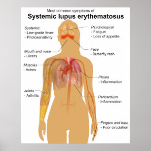 Symptom Chart of Systemic Lupus Erythematosus