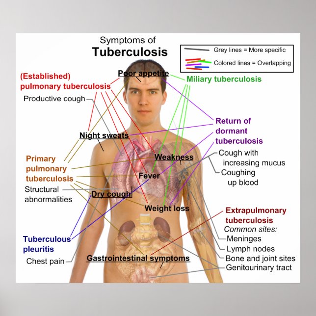 Symptom Chart of Tuberculosis in Humans (Front)