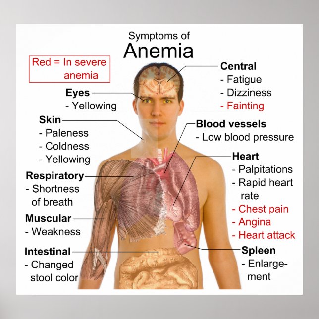Symptoms Chart of the Blood Disease Anemia (Front)
