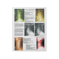 Tear Off Pad Cervical Spinal Degeneration
