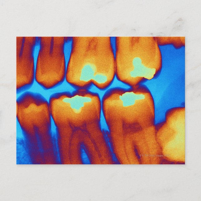 Teeth with fillings (green), coloured X-ray. Postcard (Front)