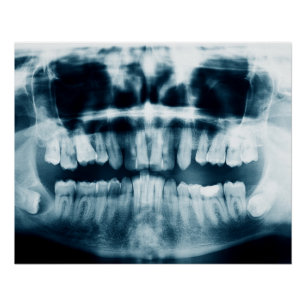 Teeth X-ray Poster