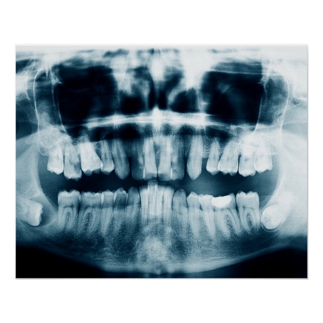 Teeth X-ray Poster (Front)