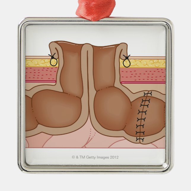 Temporary Colostomy Metal Tree Decoration (Front)