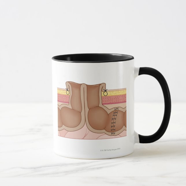 Temporary Colostomy Mug (Right)