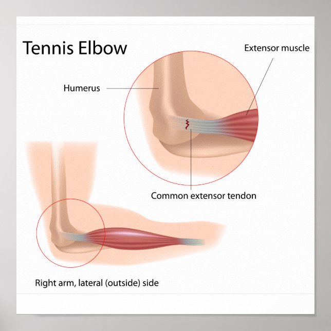 Tennis elbow Sport injury Poster (Front)