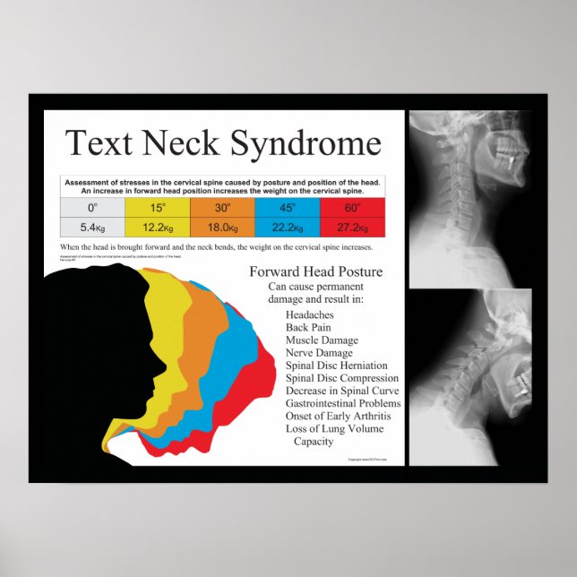 Text Neck Syndrome Chiropractic in Metric kg's Poster (Front)
