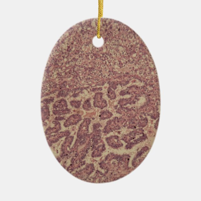 Thyroid gland cells with cancer ceramic tree decoration (Front)