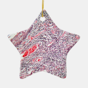 Tissue cells from a human cervix with cancer ceramic tree decoration